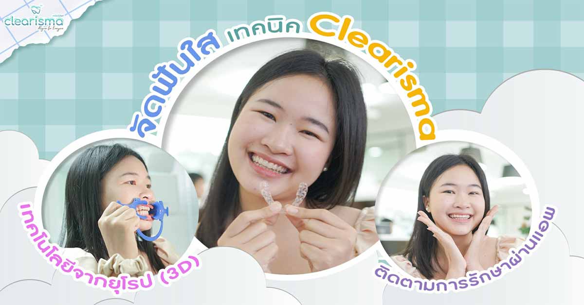 [รีวิวจัดฟันใส] จัดฟันแบบใส Clearisma จัดฟันใสราคาถูก ดัดฟันแบบนี้มีข้อดีข้อเสียยังไง?