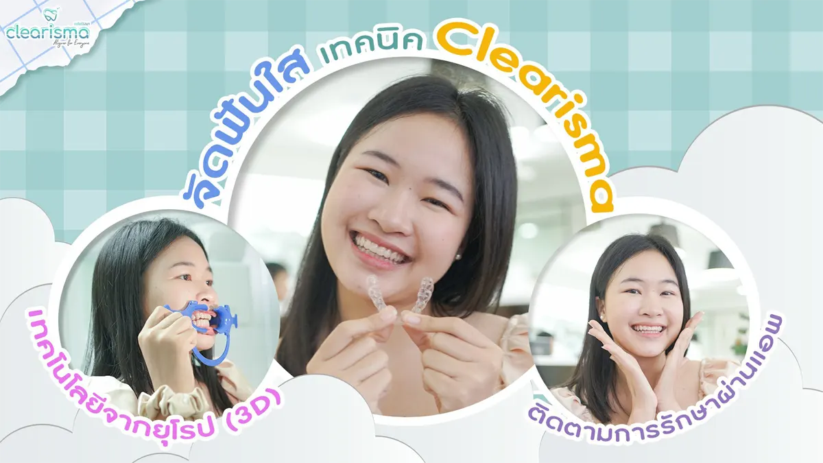 review-clearbraces-clearaligner