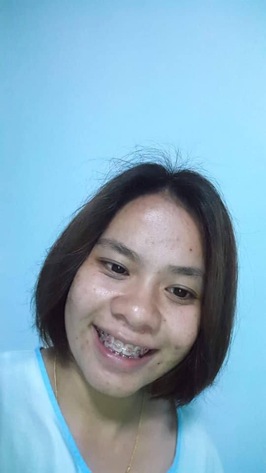จัดฟัน ดัดฟัน จัดฟันแบบใส จัดฟันใส รีวิวดัดฟันแบบใส ดัดฟันใส