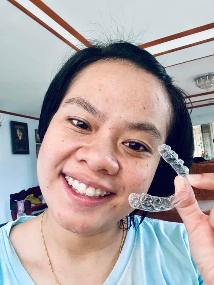 จัดฟันแบบใส จัดฟันใส รีวิวจัดฟันแบบใสกรุงเทพ