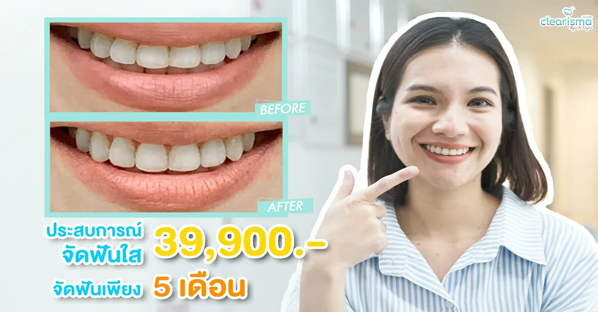 review-clear-braces-clear-aligner