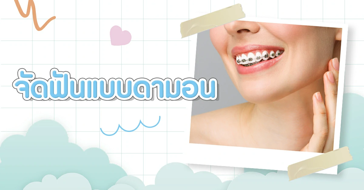 จัดฟันมีกี่แบบ