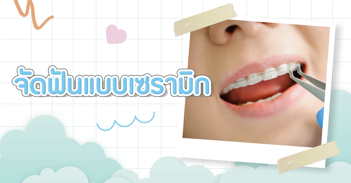 จัดฟันมีกี่แบบ