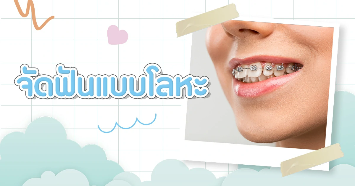 จัดฟันมีกี่แบบ