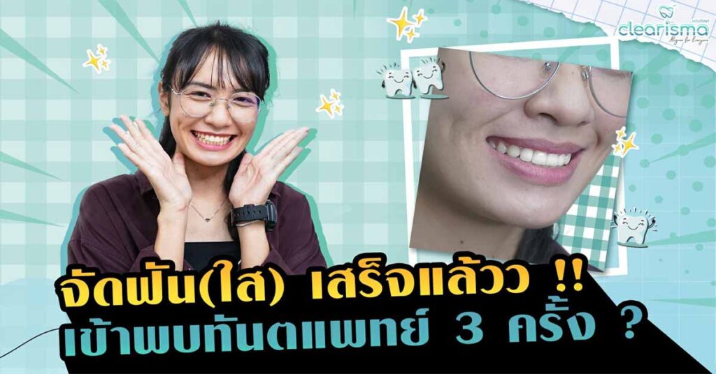 clear-aligner-review