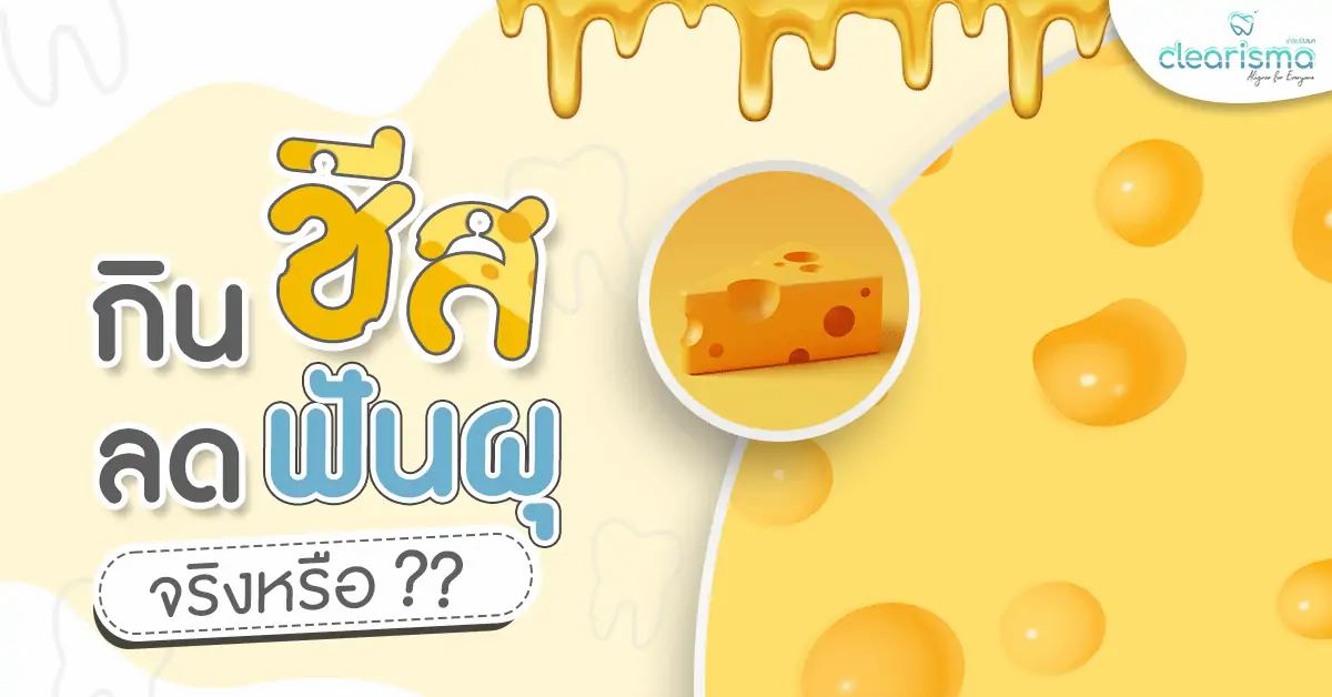 ชีสช่วย ป้องกันฟันผุ