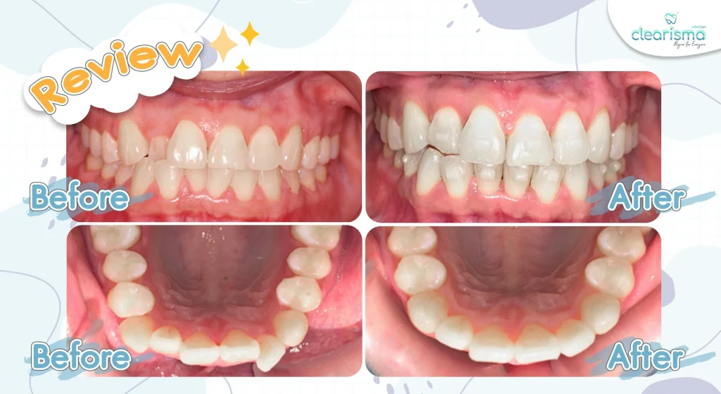 รีวิวภาพฟันคนไข้ clearisma รีวิวภาพฟันคนไข้ clearisma
