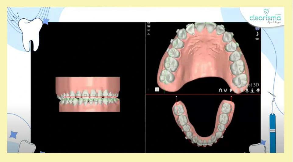 รีวิวจัดแบบใส-นีโม่