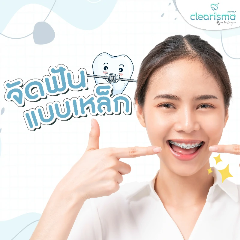 จัดฟันแบบเหล็ก