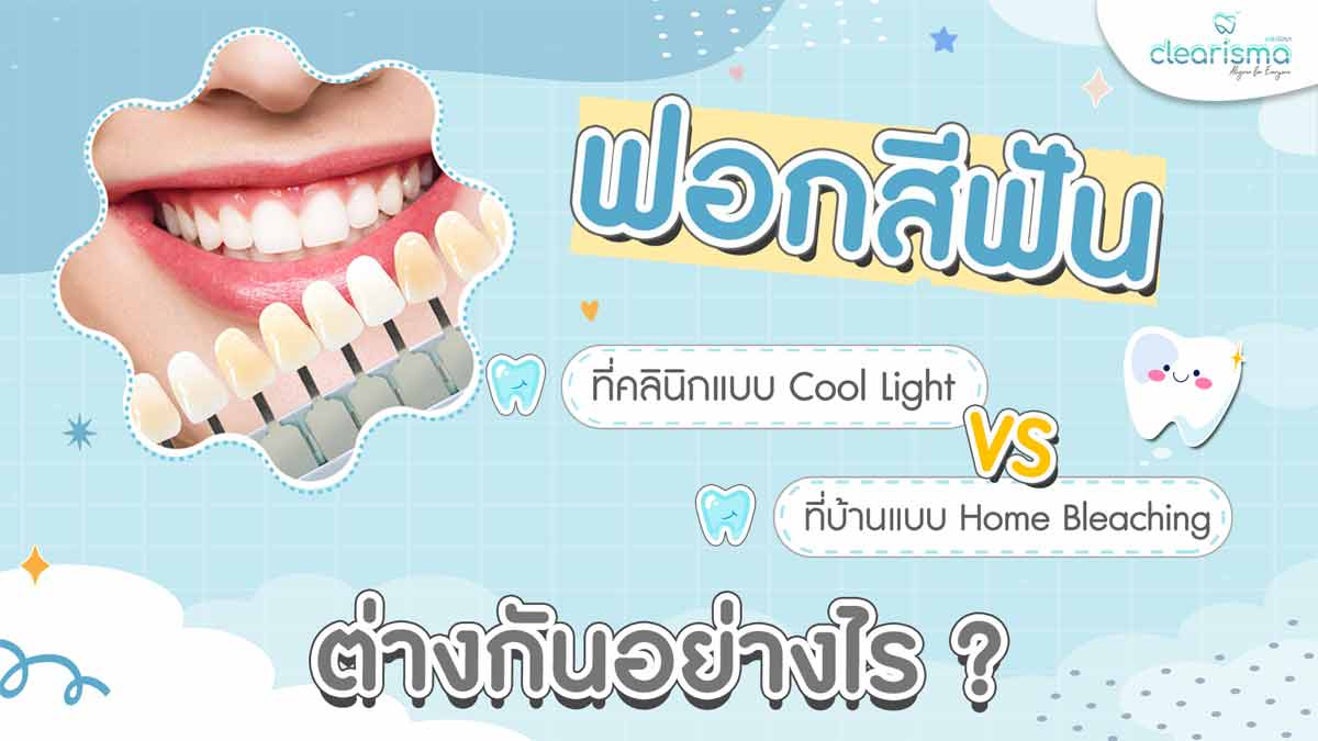 ฟอกสีฟันคลินิกกับฟอกสีฟันเอง