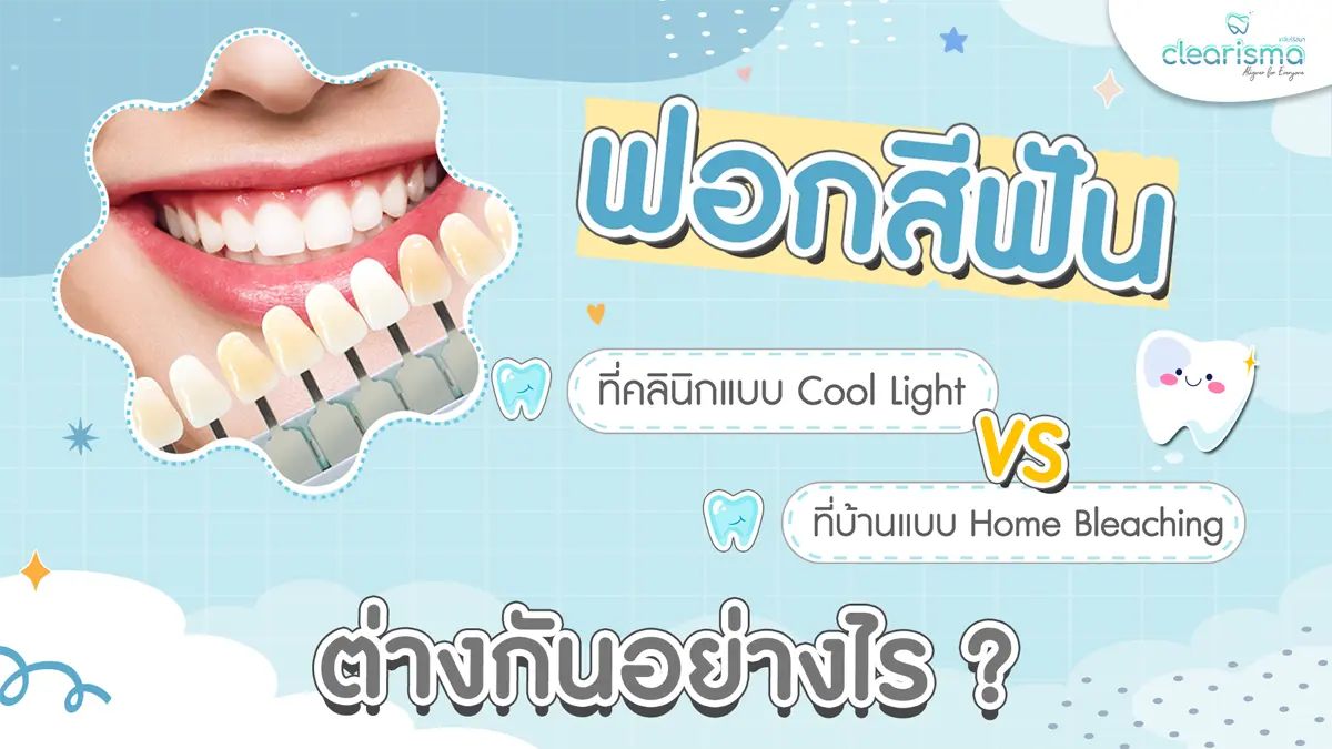 ฟอกสีฟันคลินิกกับฟอกสีฟันเอง