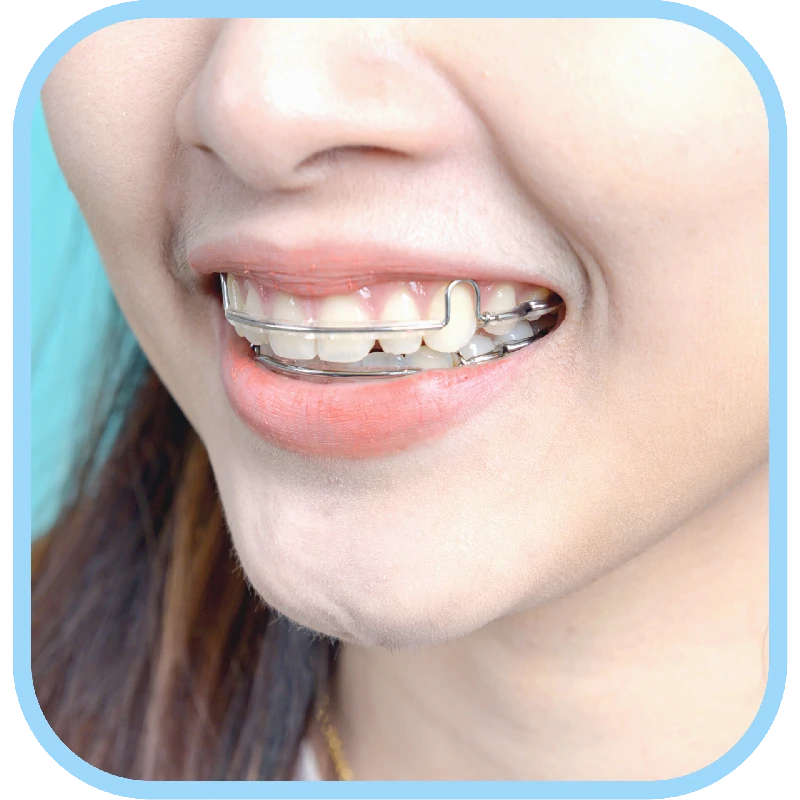 จัดฟันรอบสอง-รีเทนเนอร์แบบลวด