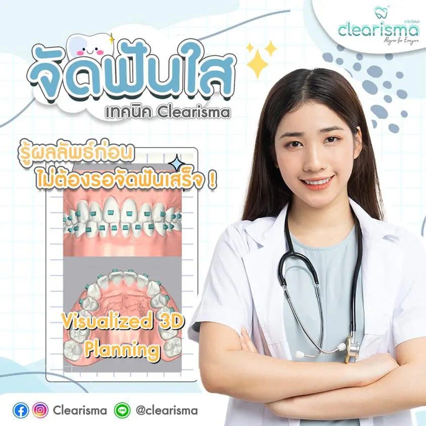 จัดฟันใสระบบคอมพิวเตอร์3มิติ