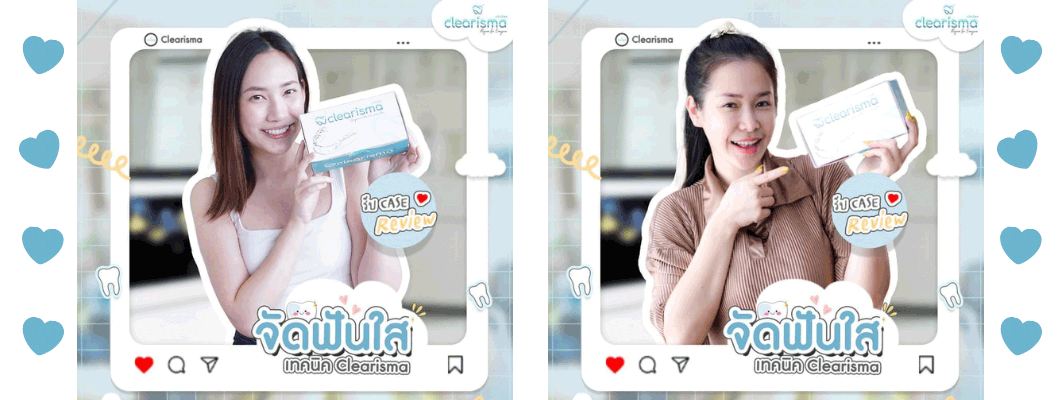 รีวิวจัดฟันใส1