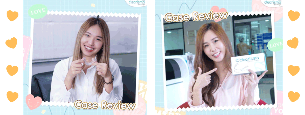 รีวิวจัดฟันใส2