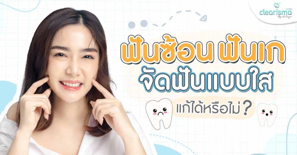 clear-braces-crowded-teeth