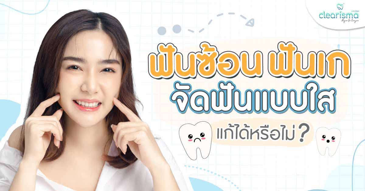 จัดฟันแบบใสแก้ไขปัญหา ฟันซ้อน ฟันเก ได้มั้ย ?