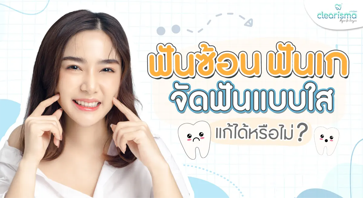 จัดฟันแบบใสแก้ปัญหาฟันซ้อนเก