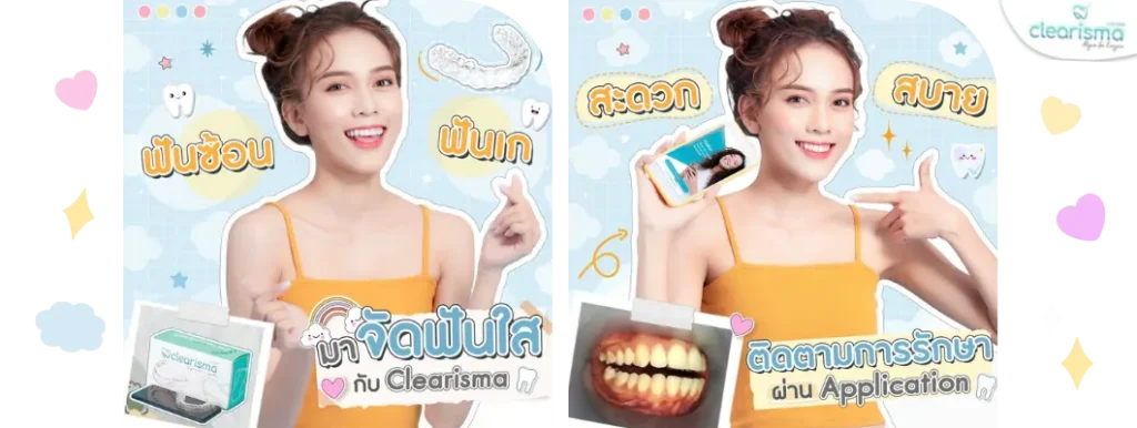 ฟันซ้อนฟันเกมาจัดฟันแบบใส