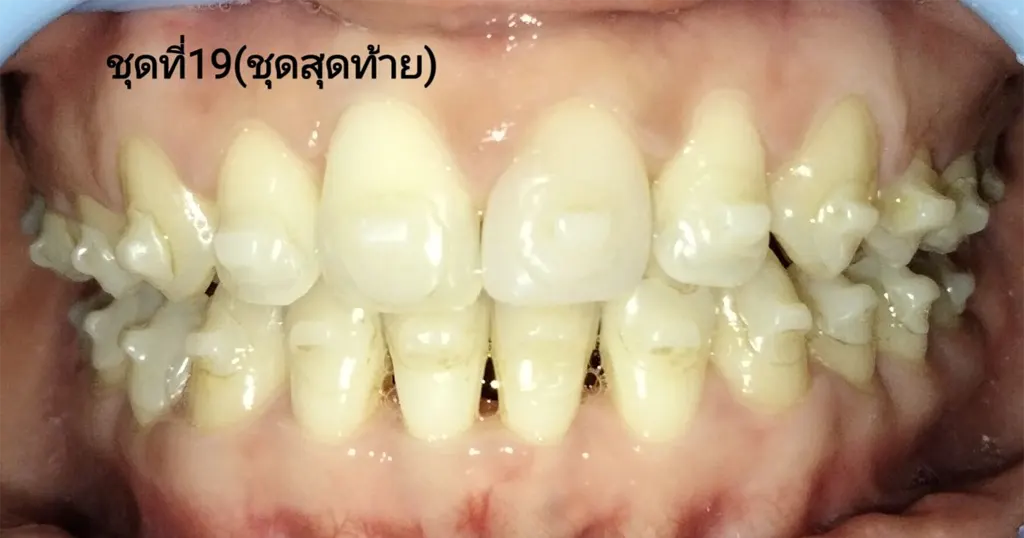 ชุดสุดท้ายคุณธิชาภรณ์