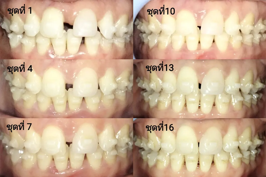 ติดตามการรักษาคุณธิชาภรณ์