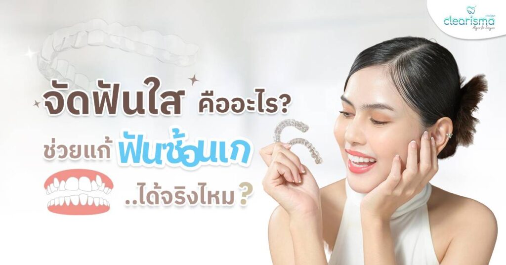 จัดฟันใสคืออะไร? ช่วยแก้ฟันซ้อนเกได้จริงไหม?