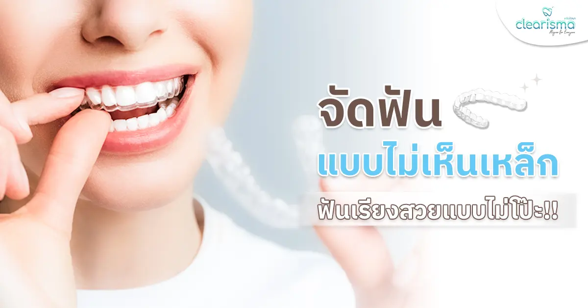 จัดฟันแบบไม่เห็นเหล็ก