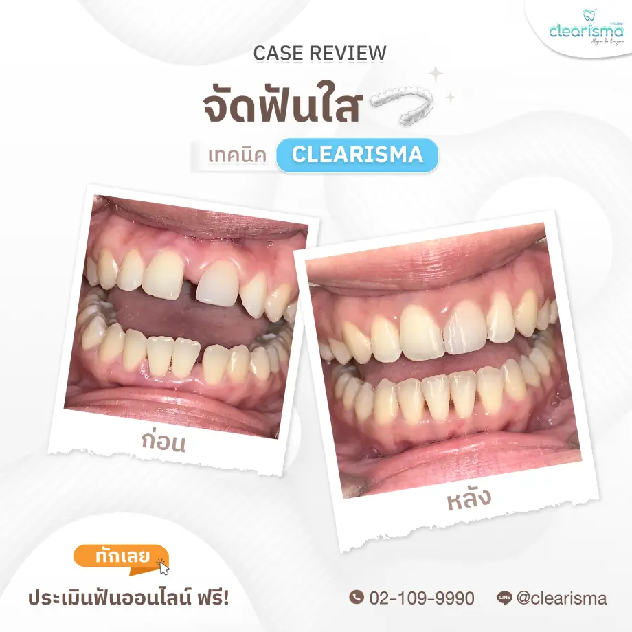 รีวิวฟันคุณธิชาภรณ์