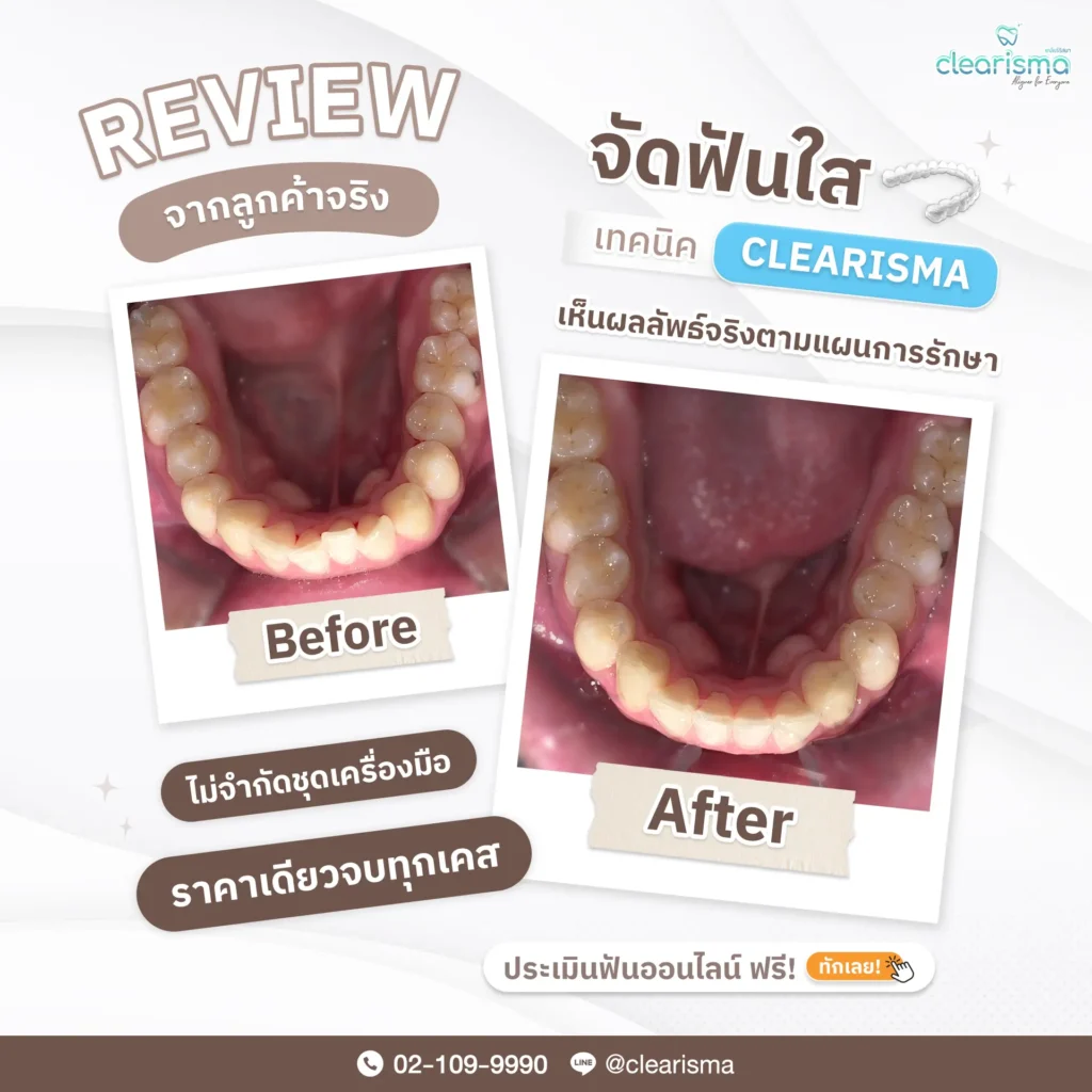 รีวิวฟันจริง