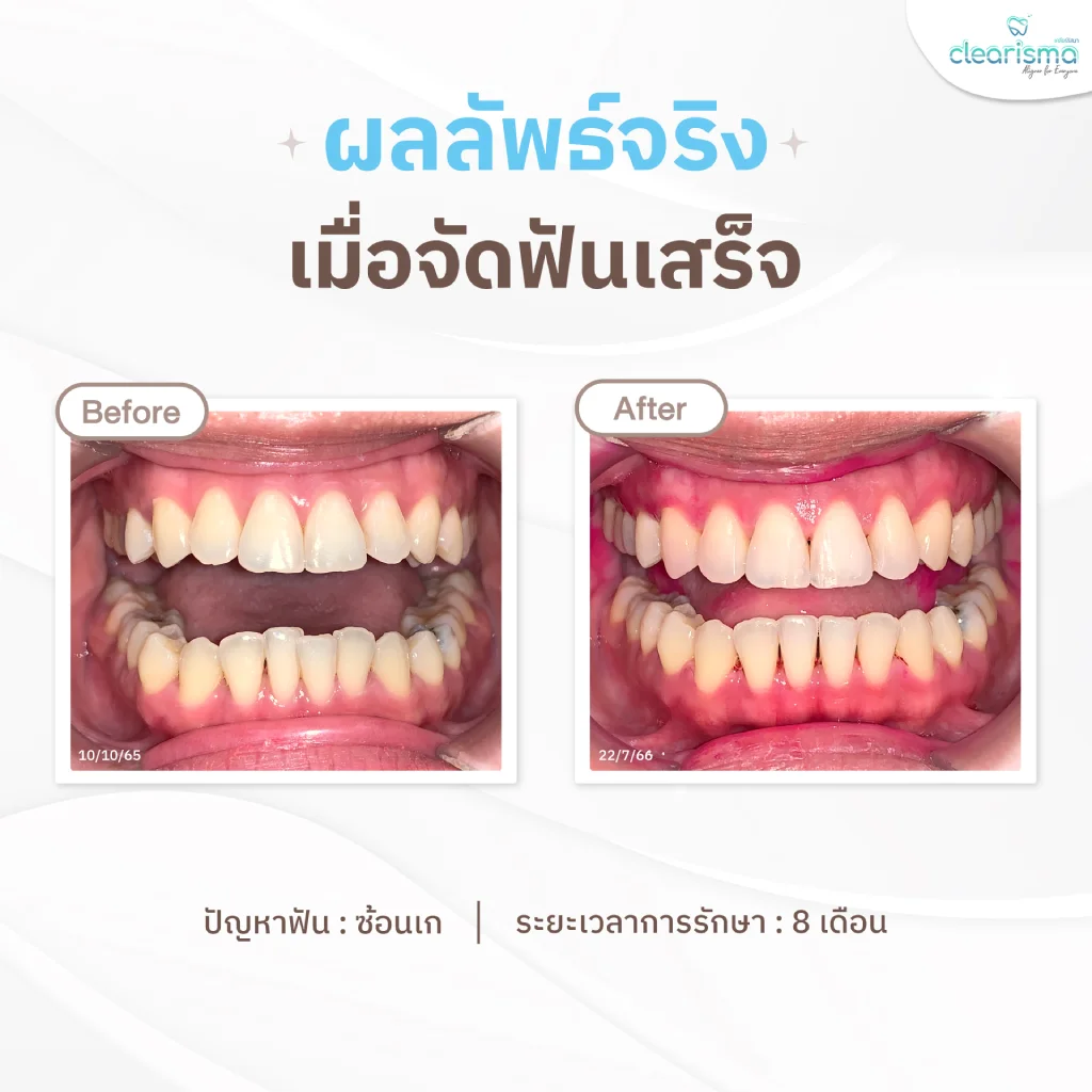 จัดฟันรอบ2 คุณดนิตา