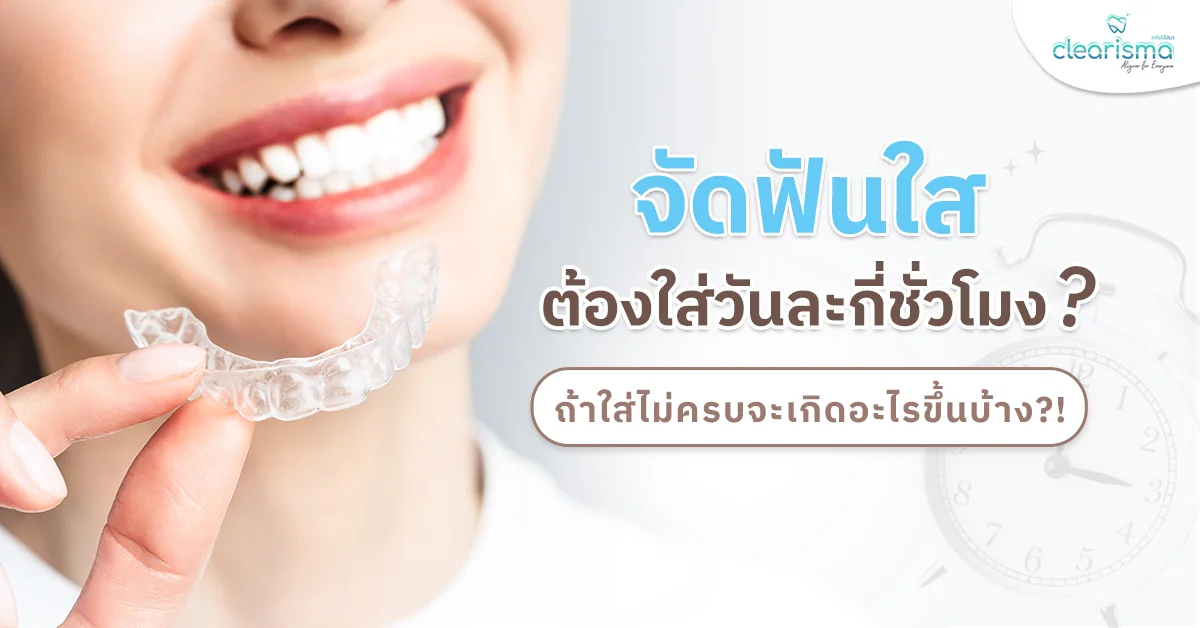 จัดฟันใสต้องใส่วันละกี่ชั่วโมง