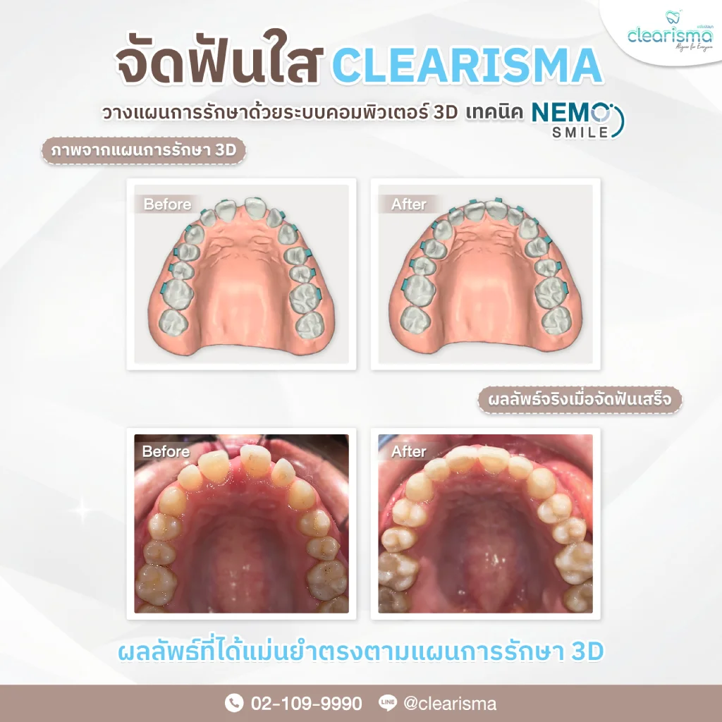 ผลลัพธ์แม่นยำ(คุณธิชาภรณ์)