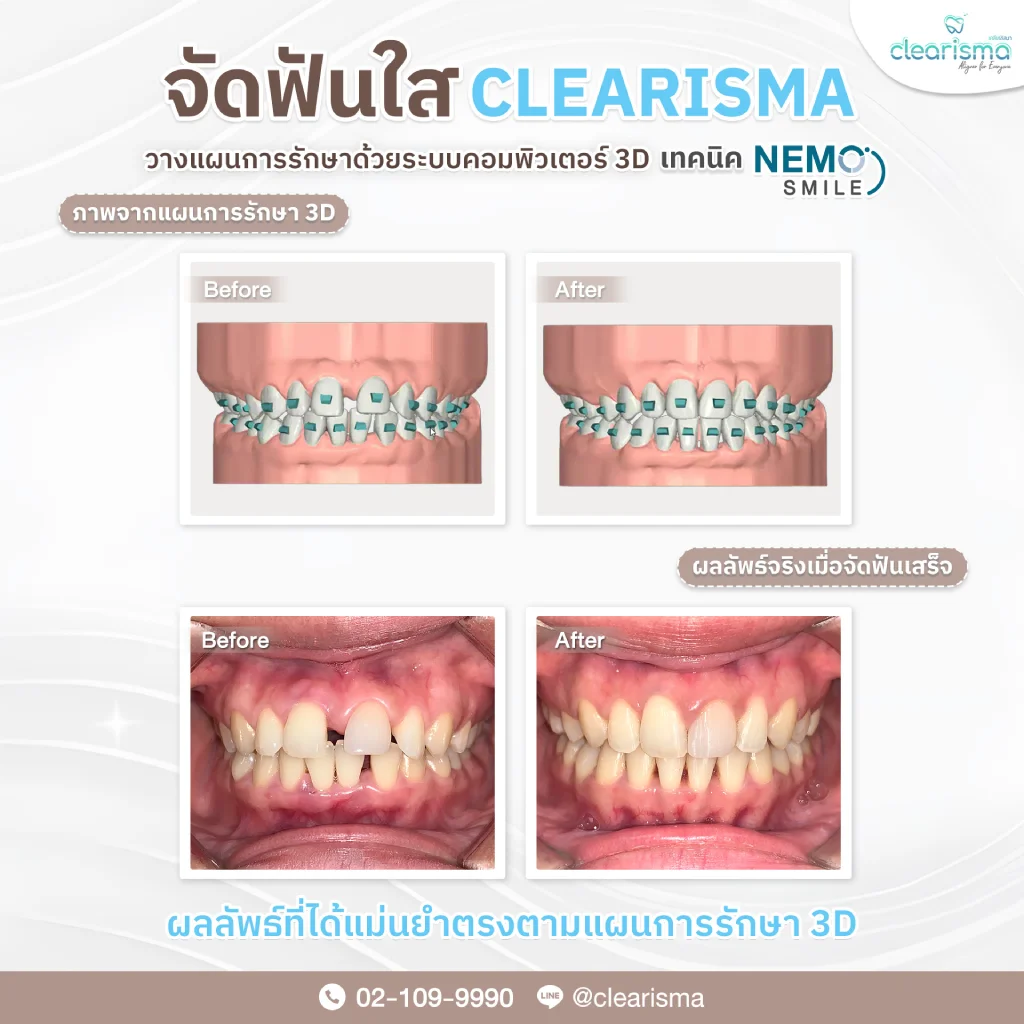 ผลลัพธ์แม่นยำ(ฟันหน้าคุณธิชาภรณ์)