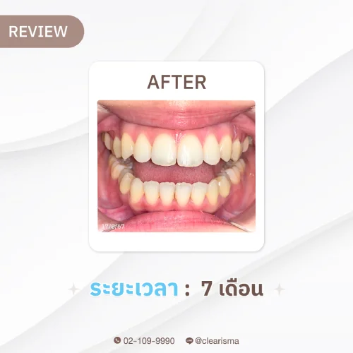 รีวิวAfter ฟันคุณเวธกา