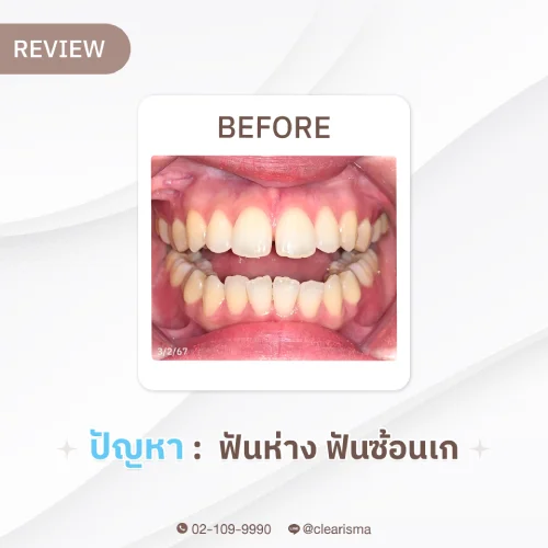 รีวิวBefore ฟันคุณเวธกา