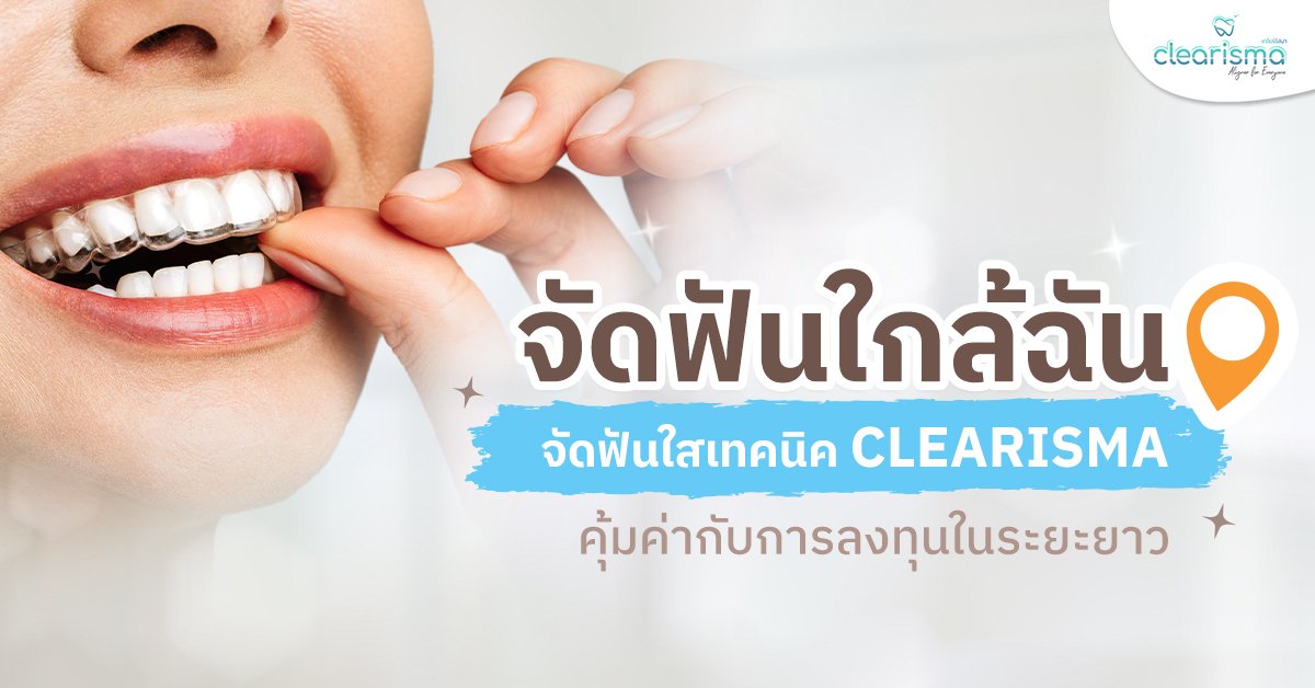จัดฟันใกล้ฉัน จัดฟันใสเทคนิค Clearisma คุ้มค่ากับการลงทุนในระยะยาว