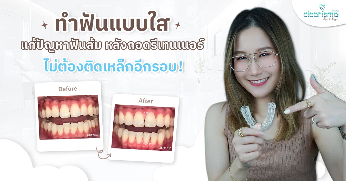 ทำฟันแบบใส แก้ปัญหาฟันล้ม