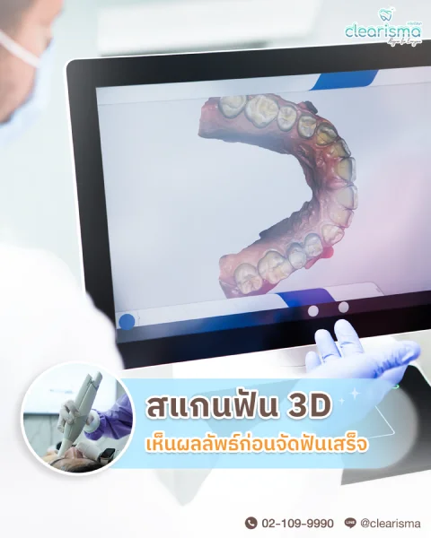 รูปจัดฟันเหล็ก vs จัดฟันใส