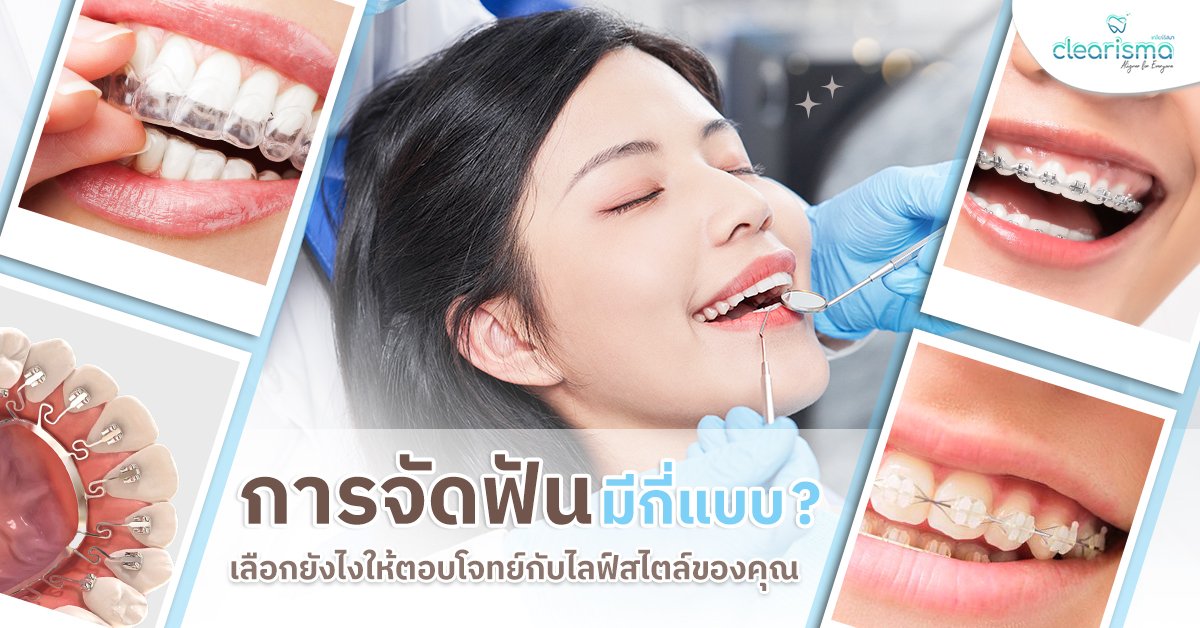 การจัดฟันมีกี่แบบ เลือกยังไงให้ตอบโจทย์กับไลฟ์สไตล์ของคุณ