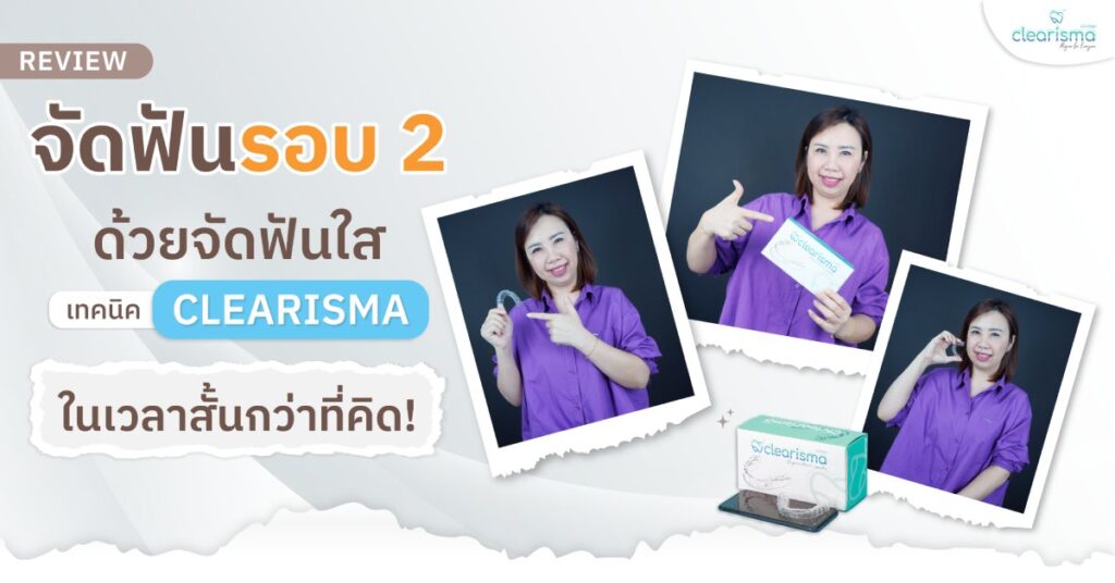 จัดฟันรอบ2 ด้วยจัดฟันใส