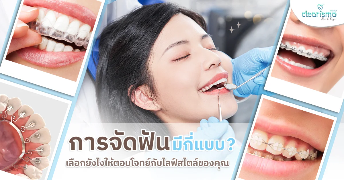 การจัดฟันมีกี่แบบ? เลือกยังไงให้ตอบโจทย์กับไลฟ์สไตล์ของคุณ