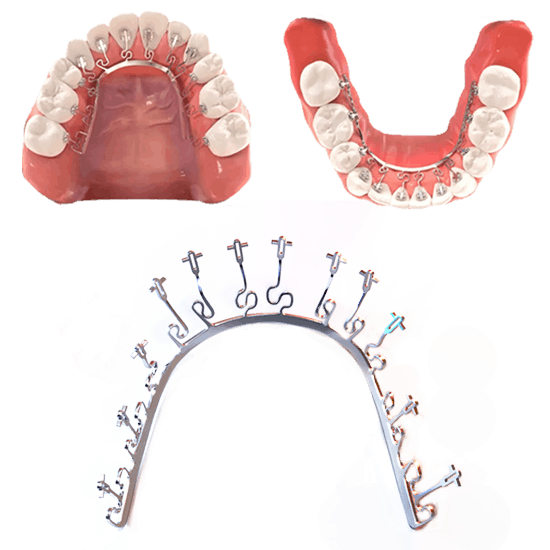 รูปจัดฟันแบบติดด้านใน
