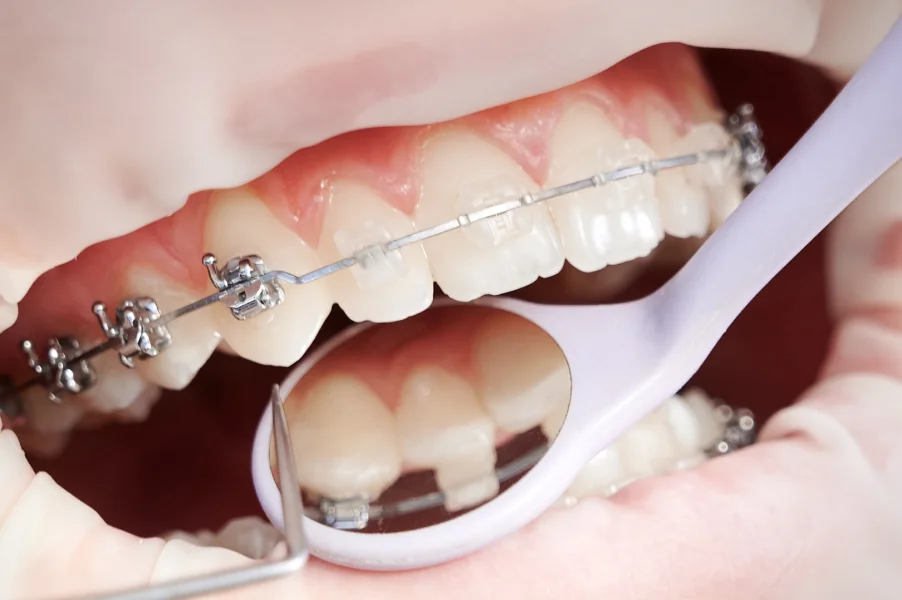 รูปจัดฟันแบบดามอน