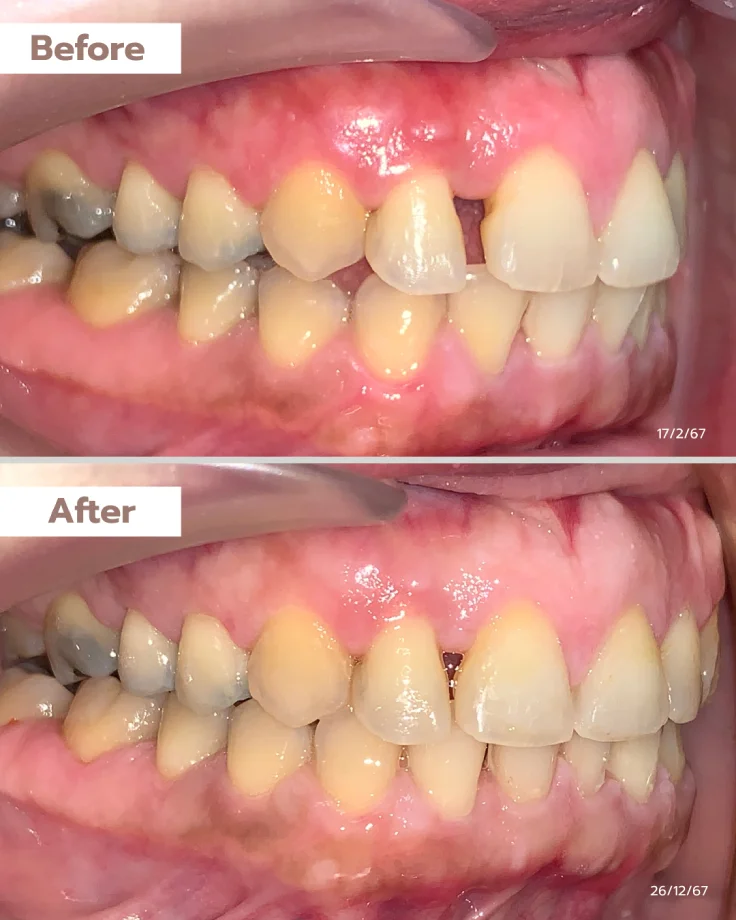 ภาพฟัน Before&After คุณนฤมล