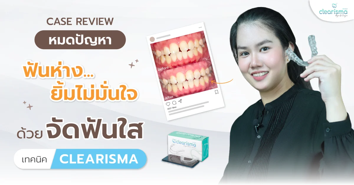 รีวิวจัดฟันใส หมดปัญหาฟันห่าง ยิ้มไม่มั่นใจ ด้วยจัดฟันใส