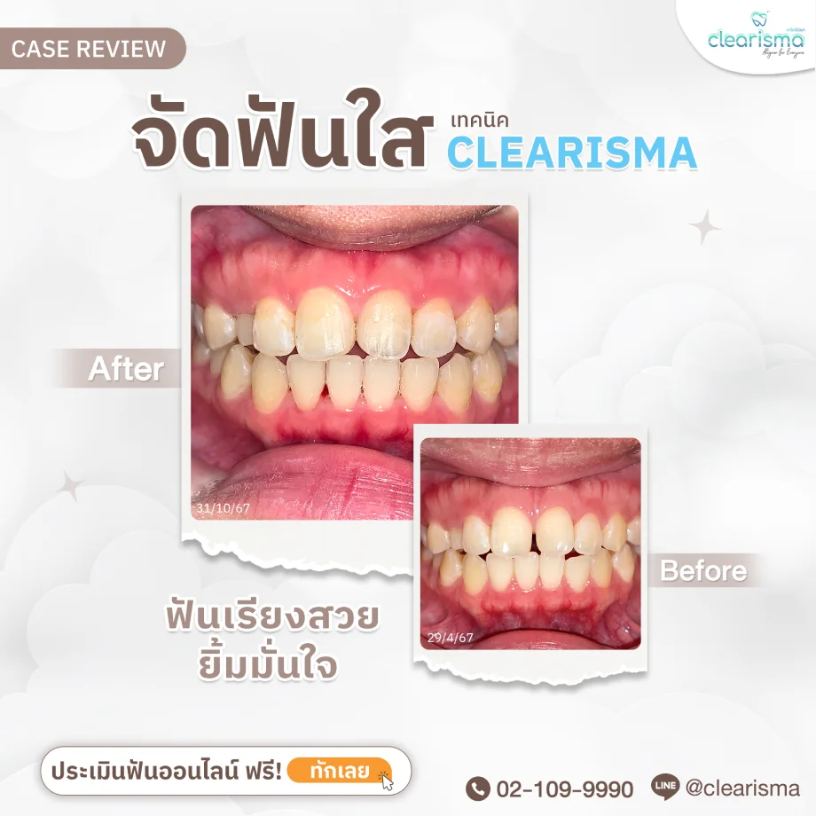 รีวิวฟันคุณนิชานันท์