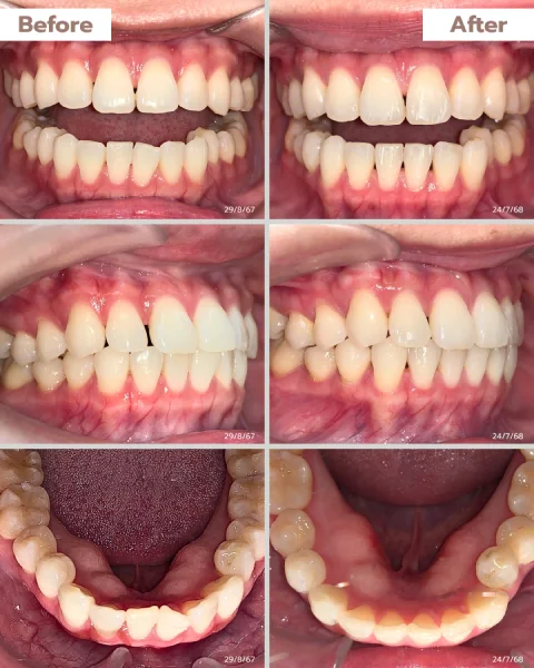 (รูป)ผลลัพธ์ฟันคุณวริศรา